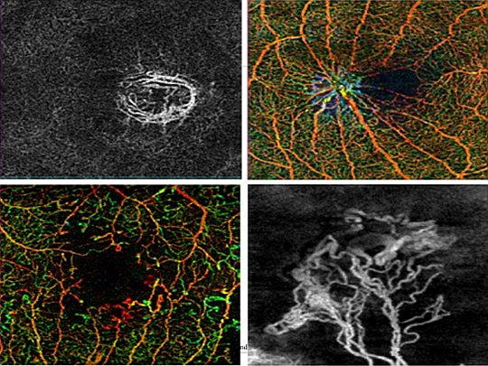 황반변성 등 망막질환, 진단 신기술 도입으로 치료결과 향상 가능성